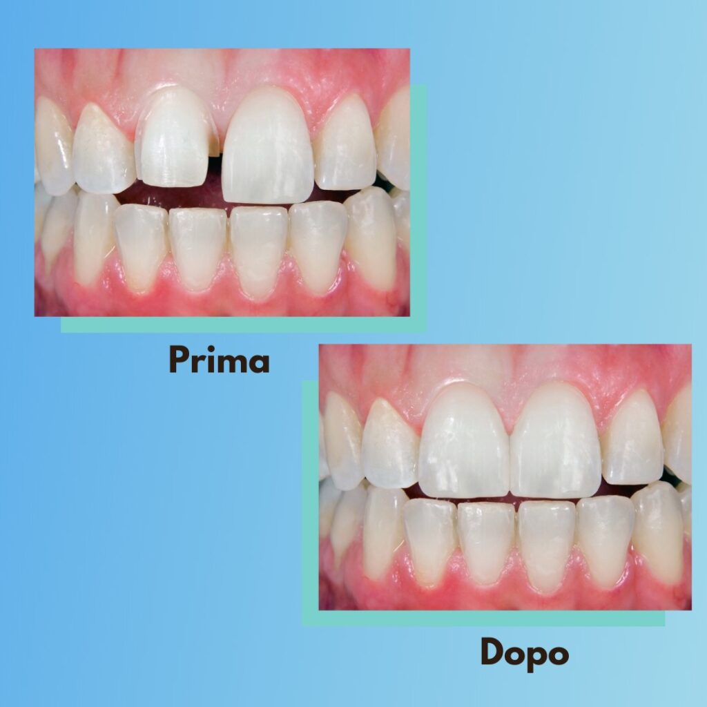 Le faccette dentali: sottili strati di ceramica progettati con precisione per tr...